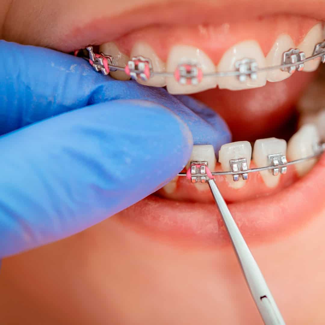 Brackets en lima