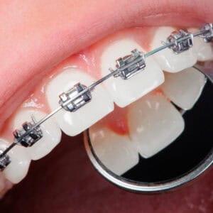 tratamiento de ortodoncia