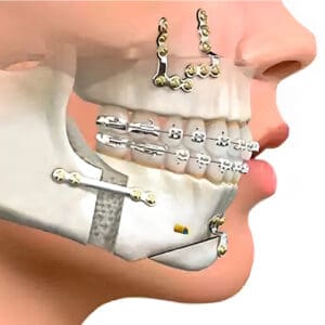 Cirugía ortognática