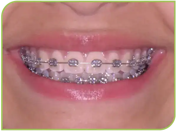 Clinica Dental Ortodoncia Brackets Surco Lima Peru