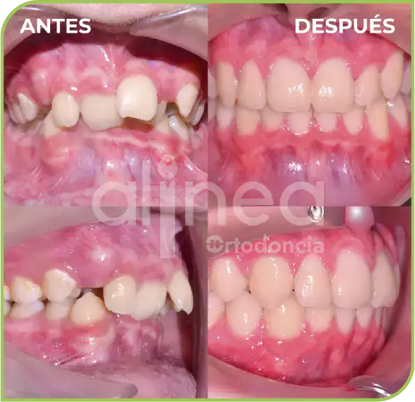 Ortodoncia Dental tratamiento ALINEA precios