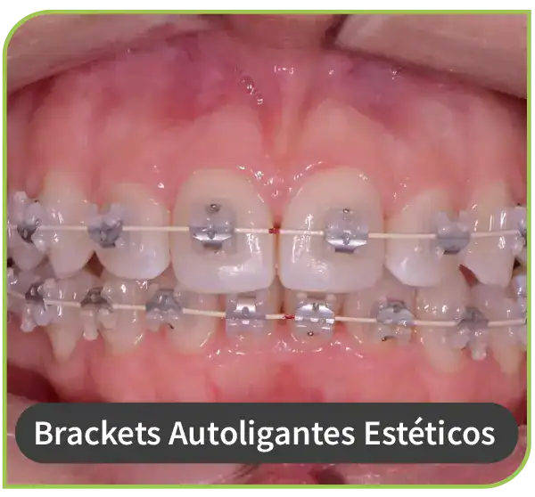 dentista especialista brackests autoligantes esteticos lima peru surco 3