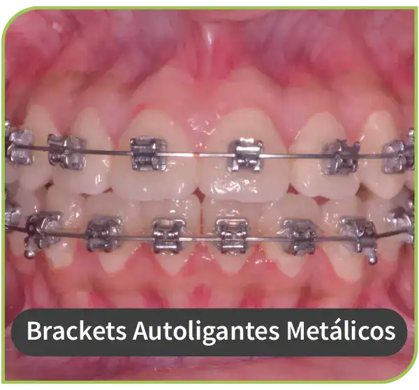 dentista especialista brackets autoligantes metalicos lima peru 3