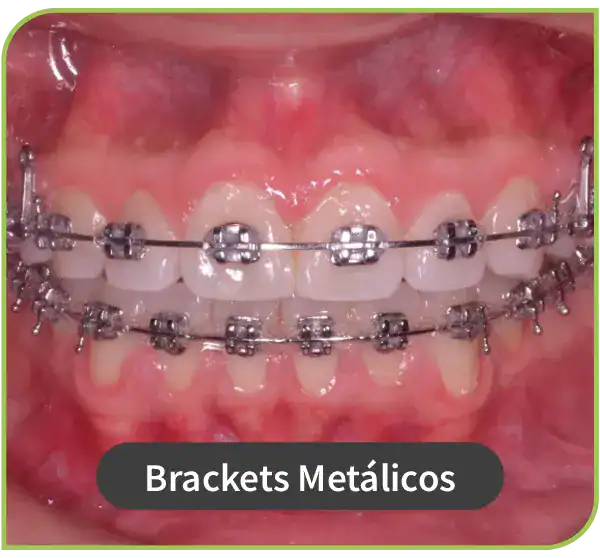 dentista especialista brackets metalicos convencionales Lima Peru 3
