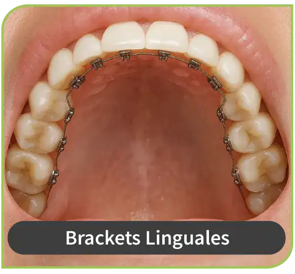 dentista experto brackets linguales lima surco 2