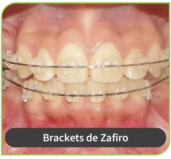 ortodoncia brackets zafiro surco lima 3