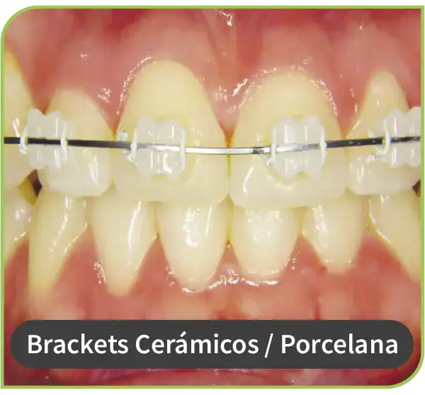 ortodoncista brackets ceramicos porcelana Lima Peru 3