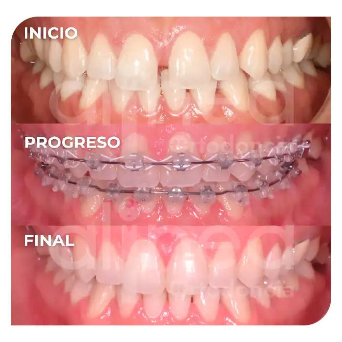 Especialista en ortodoncia diastemas brackets espacios entre los dientes surco lima 2