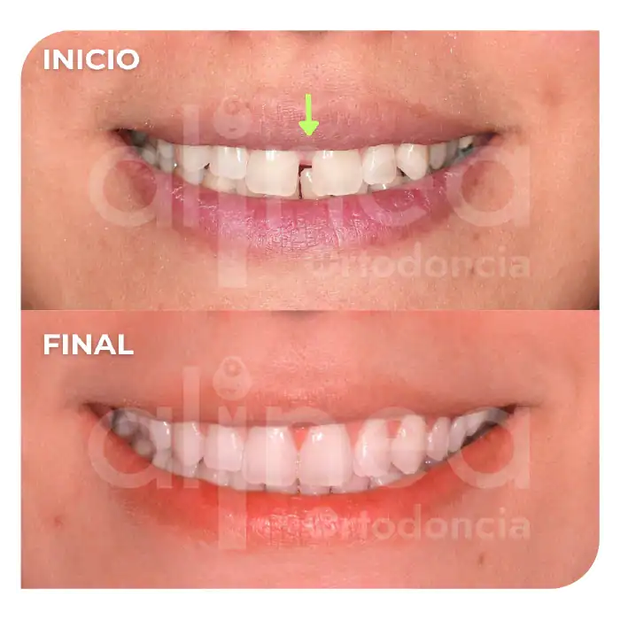 Especialista en ortodoncia diastemas brackets espacios entre los dientes surco lima1