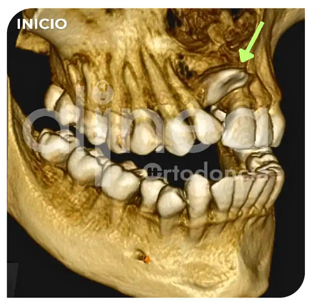 Especialista en ortodoncia diente retenido diente atrapado brackets traccion de diente supernumerario surco lima 1