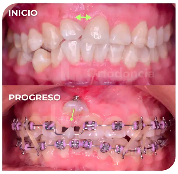 Especialista en ortodoncia diente retenido diente atrapado brackets traccion de diente supernumerario surco lima 2