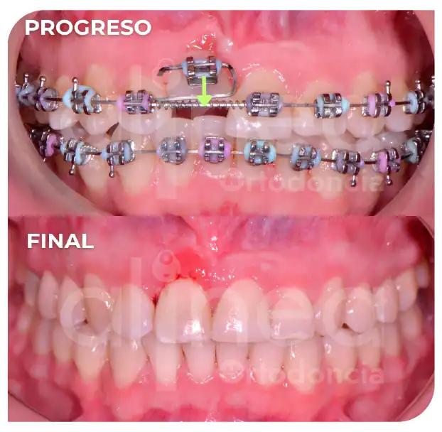 Especialista en ortodoncia diente retenido diente atrapado brackets traccion de diente supernumerario surco lima 3