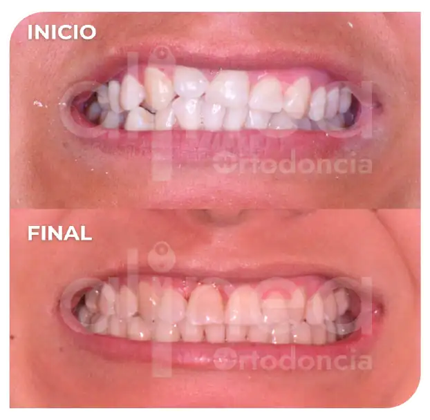 Especialista en ortodoncia diente retenido diente atrapado brackets traccion de diente supernumerario surco lima 4