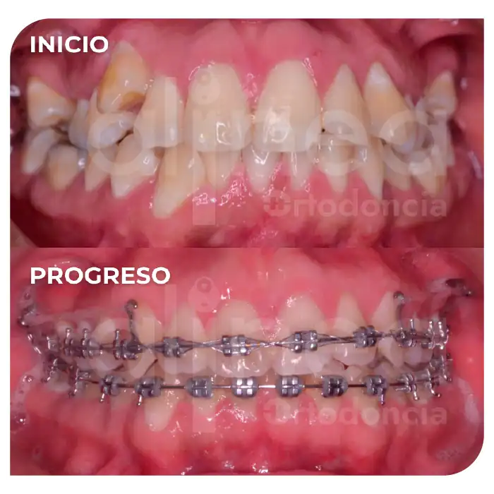 Especialista en ortodoncia dientes apiñados brackets apiñamiento severo miniimplantes minitornillos dientes chuecos surco lima 1