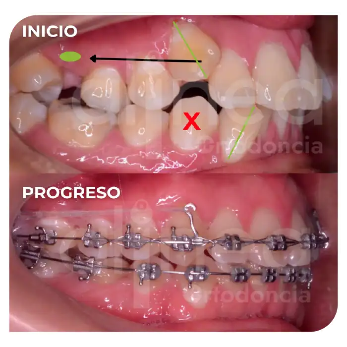 Especialista en ortodoncia dientes apiñados brackets apiñamiento severo miniimplantes minitornillos dientes chuecos surco lima 2
