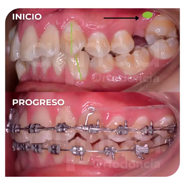 Especialista en ortodoncia dientes apiñados brackets apiñamiento severo miniimplantes minitornillos dientes chuecos surco lima 3