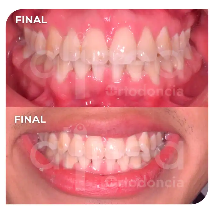 Especialista en ortodoncia dientes apiñados brackets apiñamiento severo miniimplantes minitornillos dientes chuecos surco lima 4