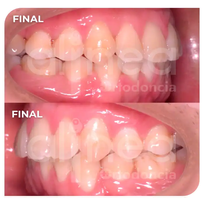 Especialista en ortodoncia dientes apiñados brackets apiñamiento severo miniimplantes minitornillos dientes chuecos surco lima 5