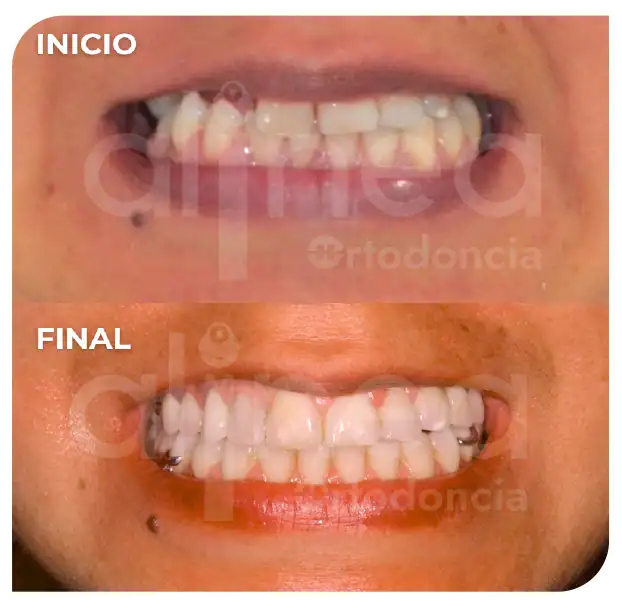 Especialista en ortodoncia preprotesica brackets en adultos protesis surco lima 1