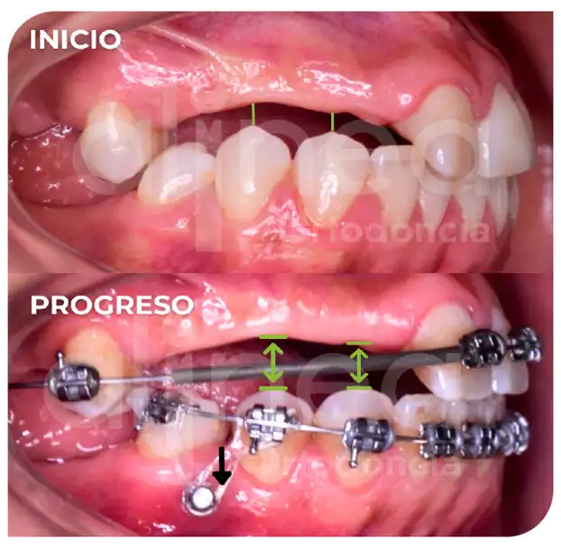 Especialista en ortodoncia preprotesica brackets en adultos protesis surco lima 2