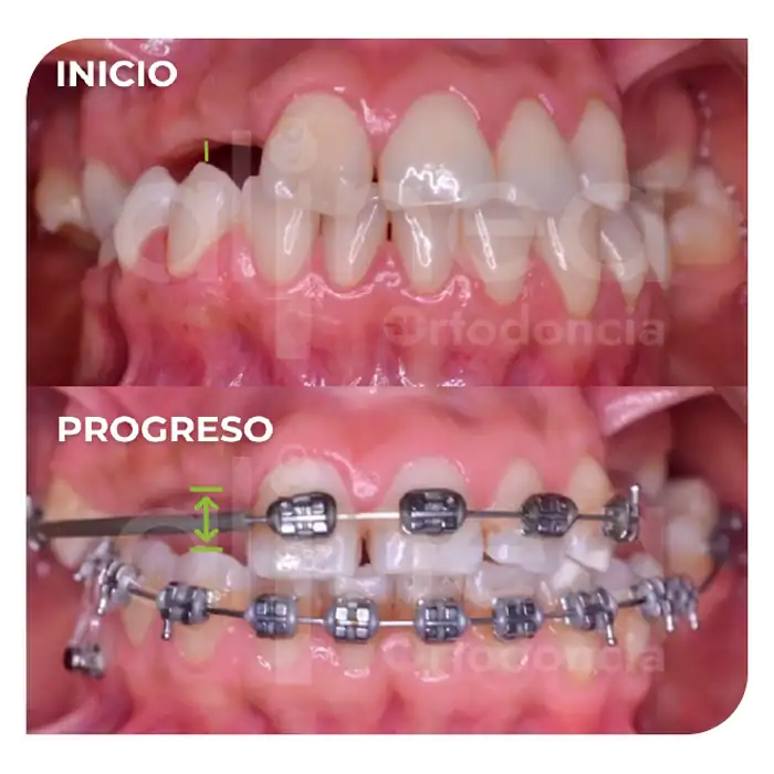 Especialista en ortodoncia preprotesica brackets en adultos protesis surco lima 3