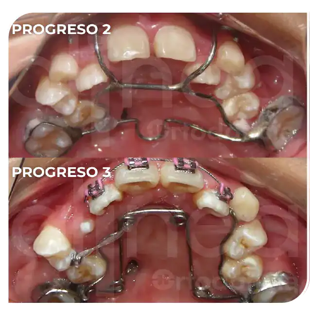 Ortodoncia en niños ortopedia maxilar brackets adolescentes labio leporino paladar fisurado surco lima 2