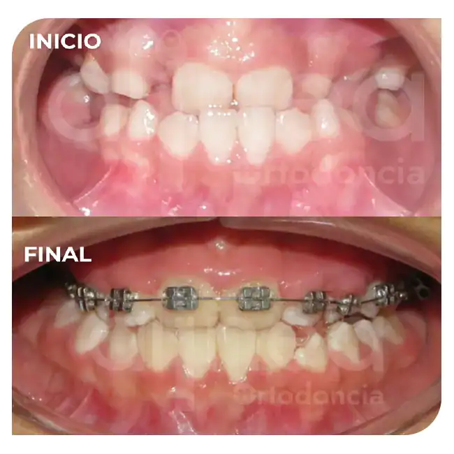 Ortodoncia en niños ortopedia maxilar brackets adolescentes labio leporino paladar fisurado surco lima 5