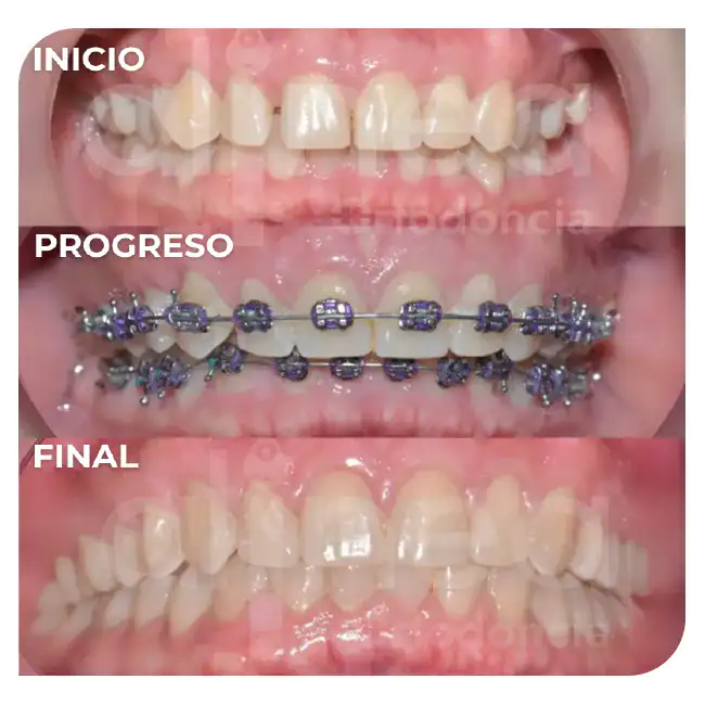 especialista en ortodoncia apiñamiento leve brackets surco lima