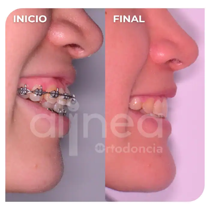 especialista en ortodoncia biprotrusion dientes muy inclinados hacia adelante cambio de perfil con brackets surco lima 1