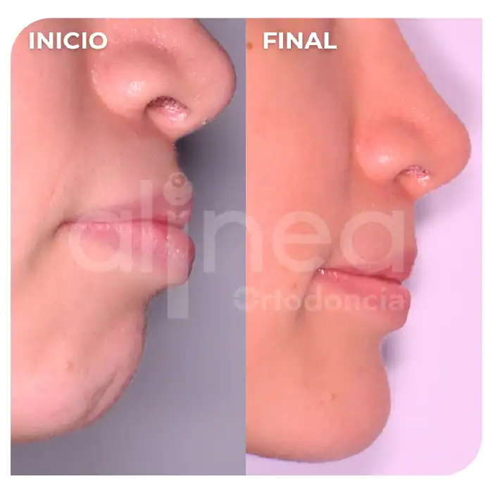 especialista en ortodoncia biprotrusion dientes muy inclinados hacia adelante cambio de perfil con brackets surco lima 2