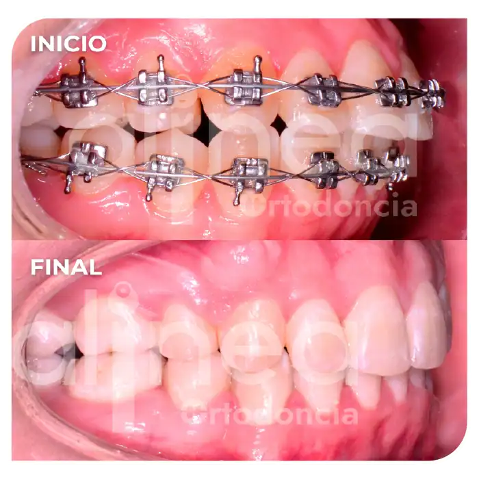 especialista en ortodoncia biprotrusion dientes muy inclinados hacia adelante cambio de perfil con brackets surco lima 3