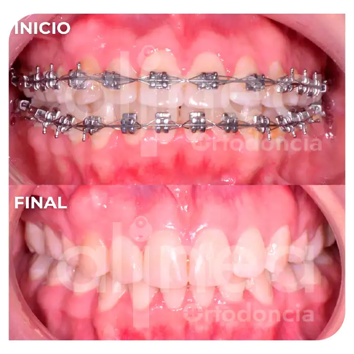 especialista en ortodoncia biprotrusion dientes muy inclinados hacia adelante cambio de perfil con brackets surco lima 4