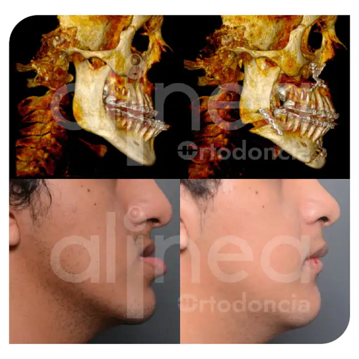 especialista en ortodoncia con cirugia ortognatica de los maxilares brackets cirugia maxilofacial mandibula grande prognatismo mandibula pequeña 1