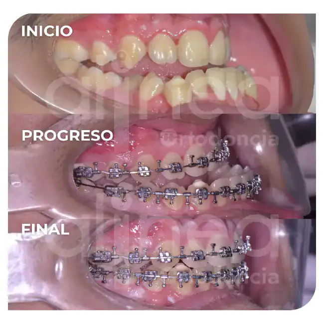 especialista en ortodoncia con cirugia ortognatica de los maxilares brackets cirugia maxilofacial mandibula grande prognatismo mandibula pequeña 2