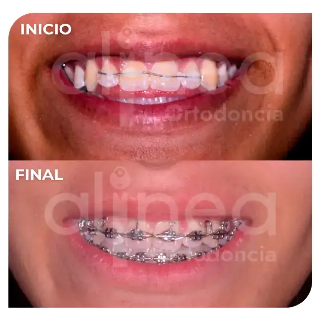 especialista en ortodoncia mordida abierta brackets por segunda vez retratamiento surco lima 1