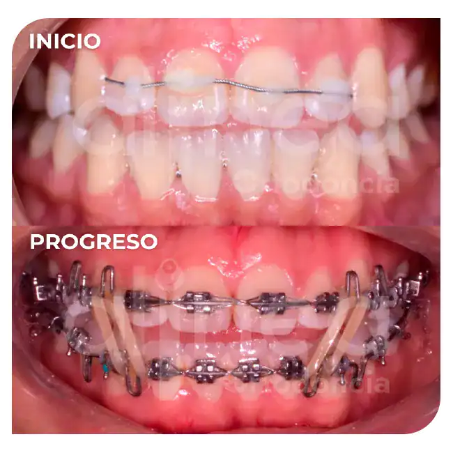 especialista en ortodoncia mordida abierta brackets por segunda vez retratamiento surco lima 2