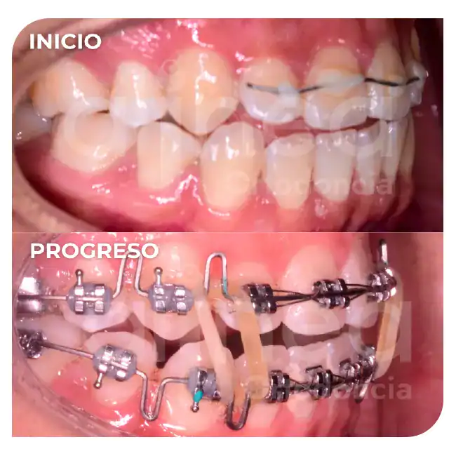 especialista en ortodoncia mordida abierta brackets por segunda vez retratamiento surco lima 3