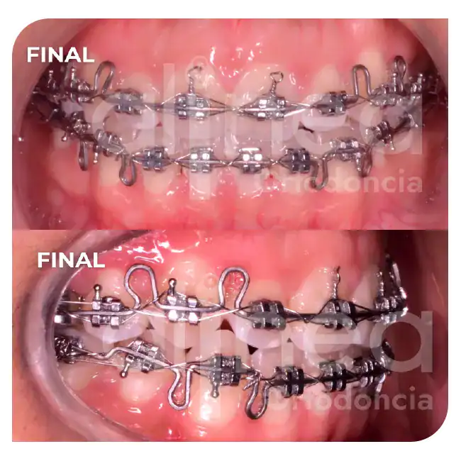 especialista en ortodoncia mordida abierta brackets por segunda vez retratamiento surco lima 4