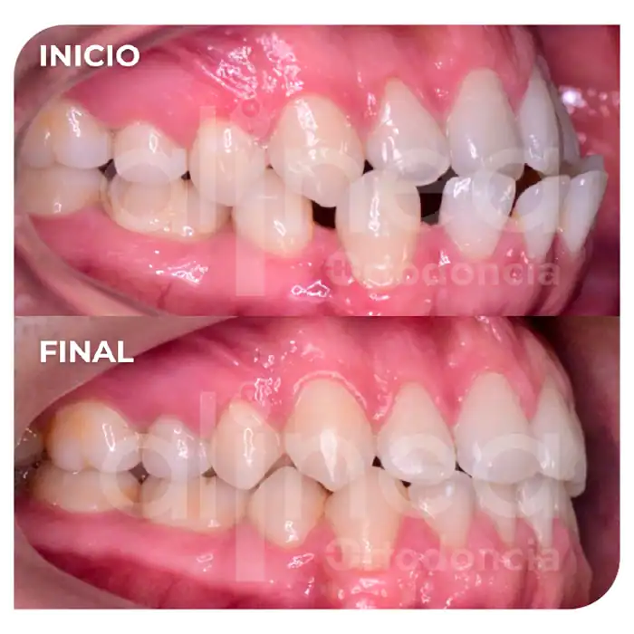 especialista en ortodoncia mordida invertida clase III dental brackets mordida cruzada surco lima 1