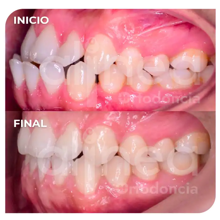 especialista en ortodoncia mordida invertida clase III dental brackets mordida cruzada surco lima 2
