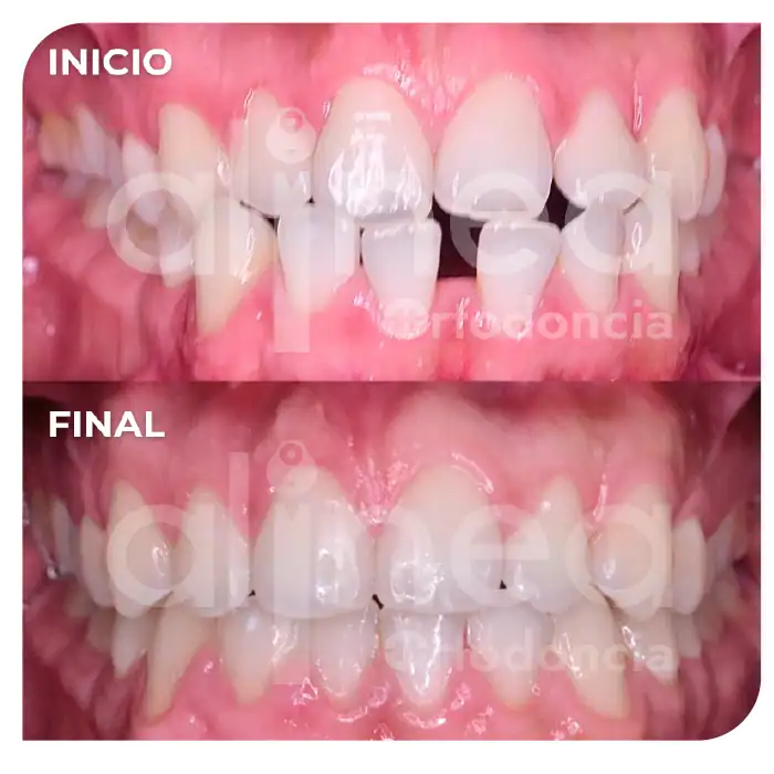 especialista en ortodoncia mordida invertida clase III dental brackets mordida cruzada surco lima 3