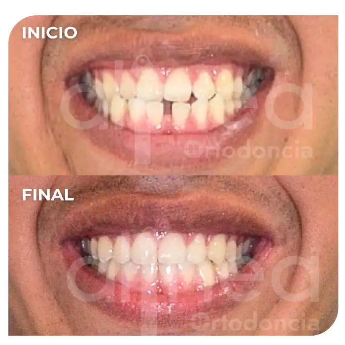 especialista en ortodoncia mordida invertida clase III dental brackets mordida cruzada surco lima 4