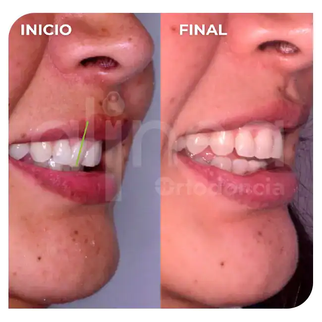 especialista en ortodoncia mordida profunda brackets dientes inclinados hacia atras 1