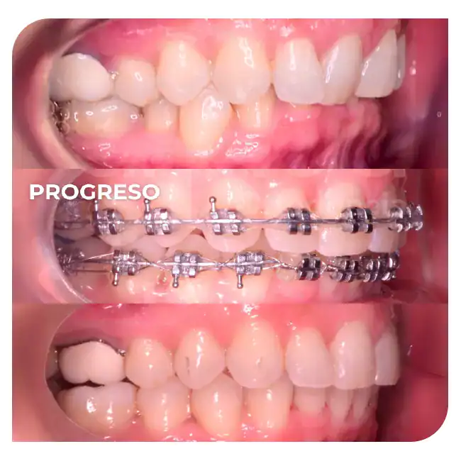 especialista en ortodoncia mordida profunda brackets dientes inclinados hacia atras 2