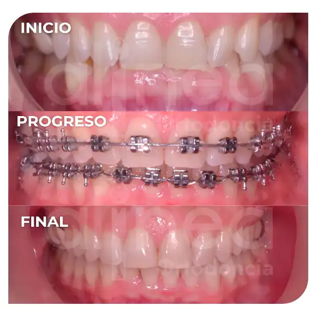 especialista en ortodoncia mordida profunda brackets dientes inclinados hacia atras 3