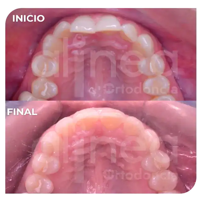especialista en ortodoncia mordida profunda brackets dientes inclinados hacia atras 4