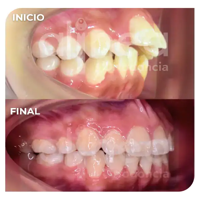 especialista en protrusion dental clase II 1 brackets dientes salidos inclinados hacia adelante 1
