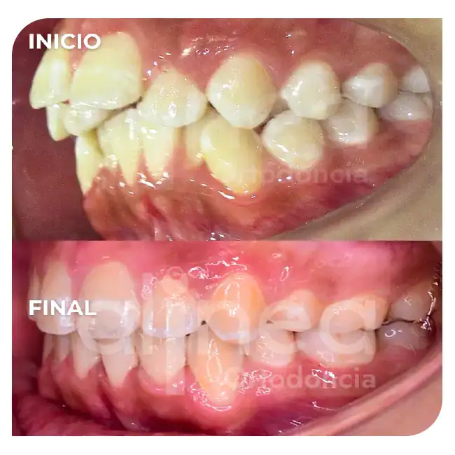 especialista en protrusion dental clase II 1 brackets dientes salidos inclinados hacia adelante 2