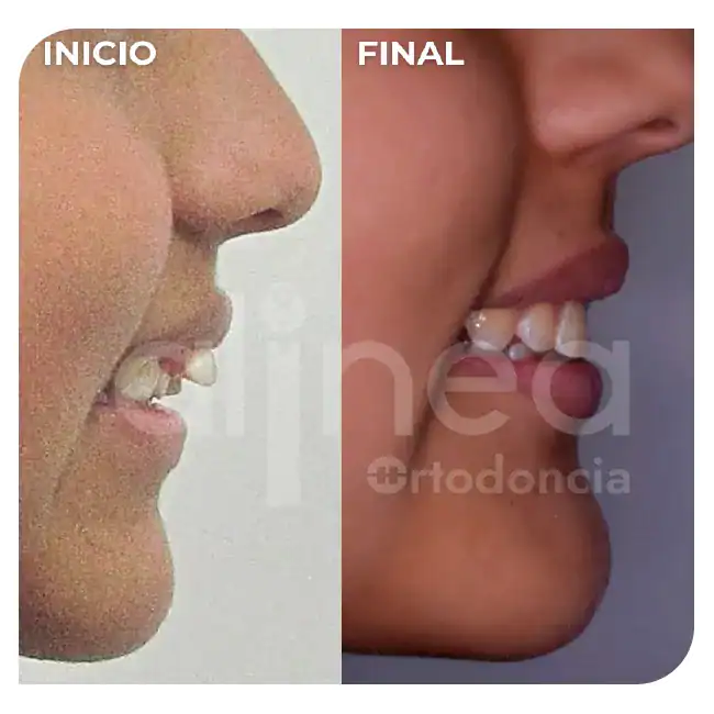 especialista en protrusion dental clase II 1 brackets dientes salidos inclinados hacia adelante 3