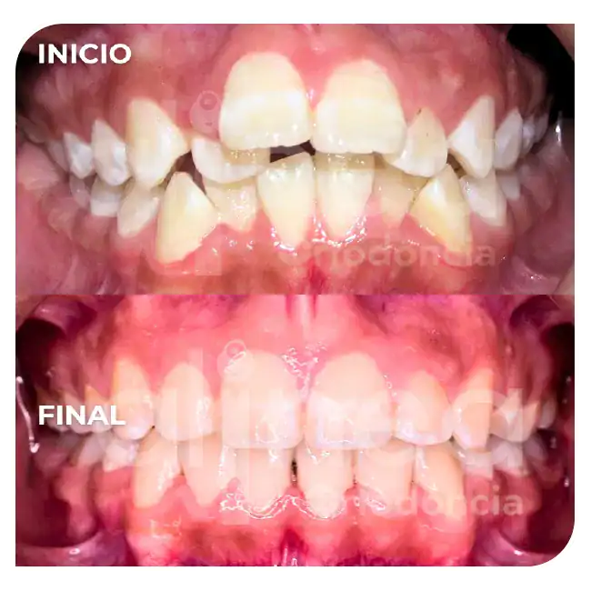 especialista en protrusion dental clase II 1 brackets dientes salidos inclinados hacia adelante 4_